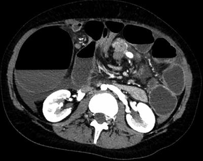 Case Report: Gut and spleen anomalies associated with DYRK1A syndrome